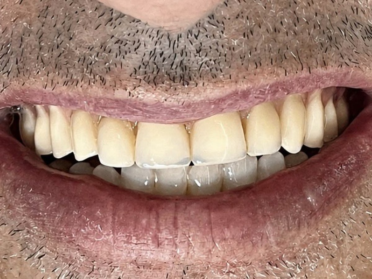 Sorriso do paciente antes do tratamento, com dentes amarelados e desalinhados
